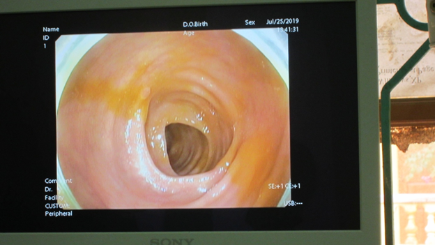 Trung tâm Y tế thành phố Yên Bái triển khai kỹ thuật nội soi đại tràng