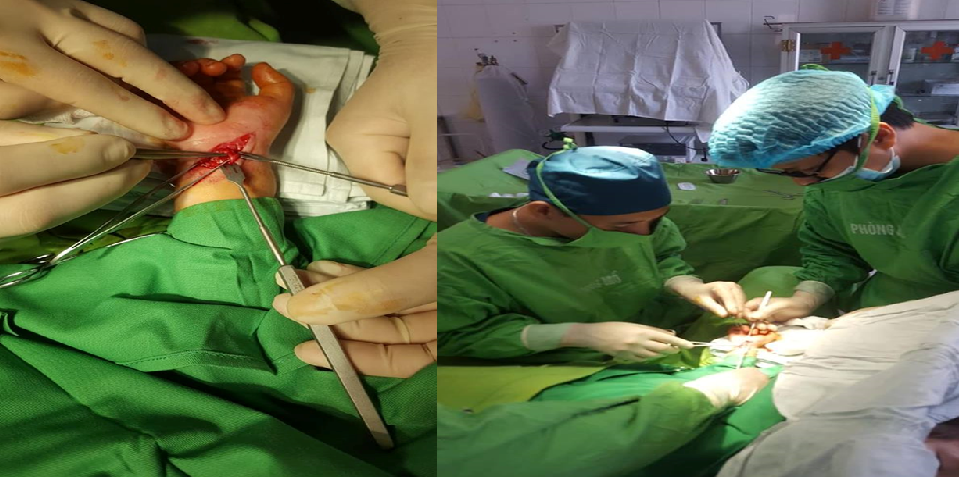 Trung tâm Y tế thành phố Yên Bái Phẫu thuật thành công nối gân-thần kinh