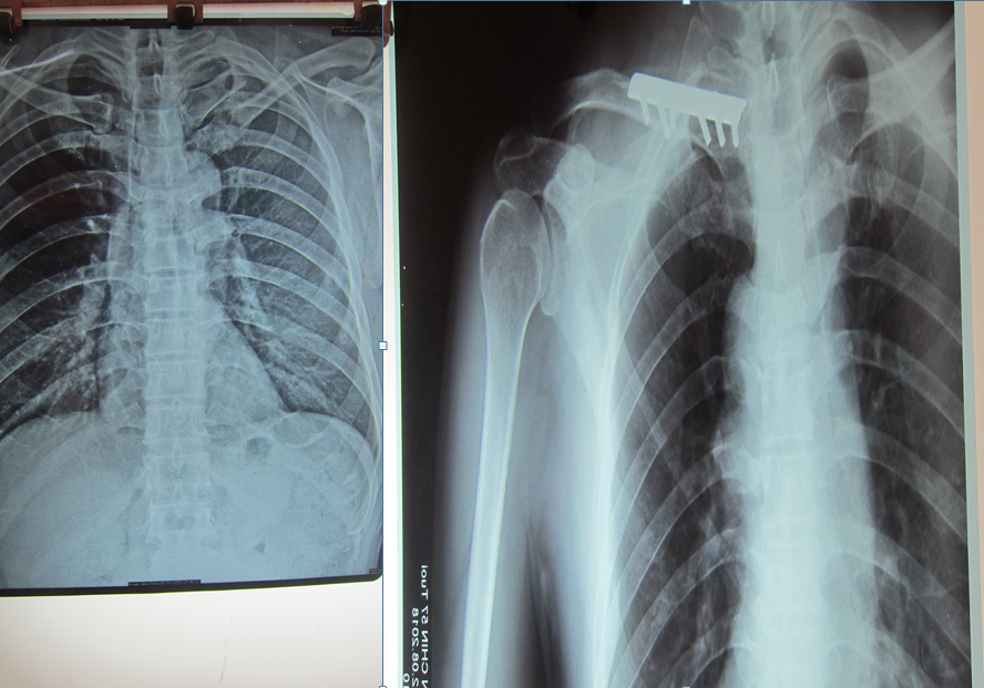 Phẫu thuật xương đòn tại Trung tâm Y tế thành phố Yên Bái