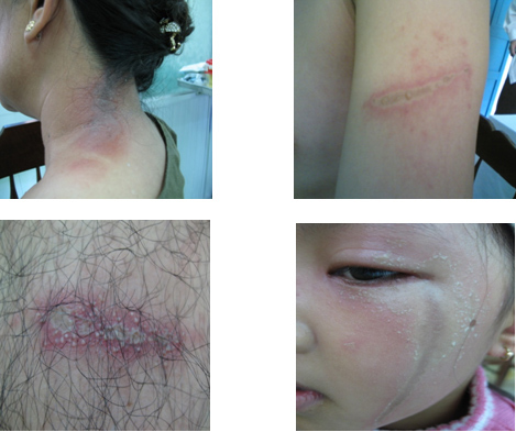 Hình ảnh tin tức Phân biệt bệnh viêm da do kiến ba khoang và zona