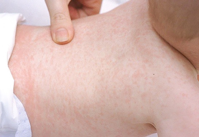 Chuyên gia hướng dẫn theo dõi, phát hiện, phòng tránh biến chứng hậu COVID-19 ở trẻ em